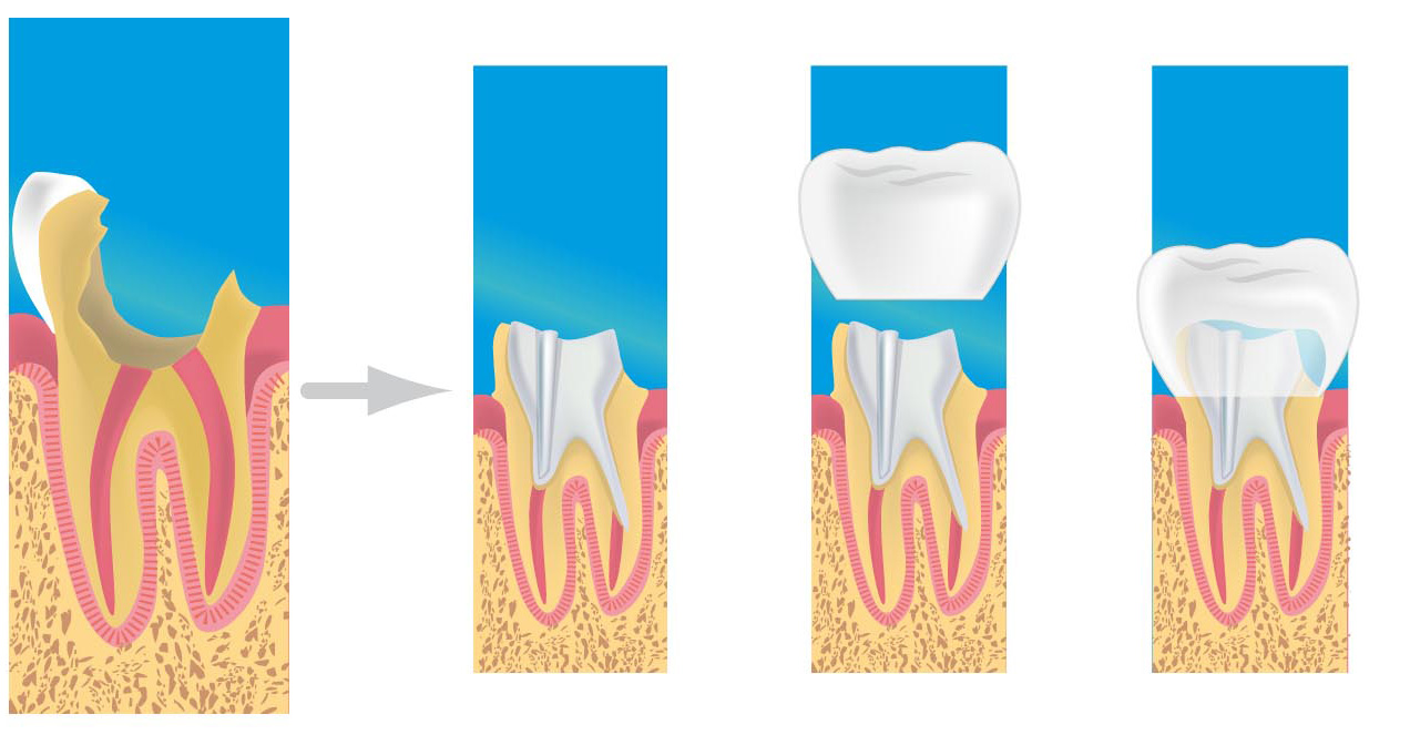Prothèses dentaires Limoges